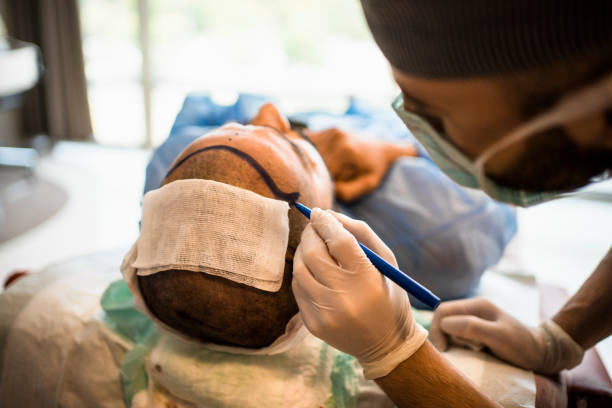 Hair Transplant